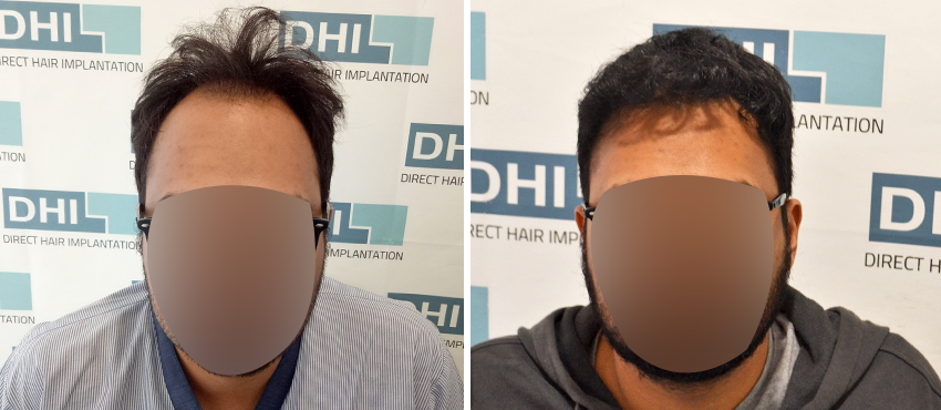 DHI before & after hair transplant results